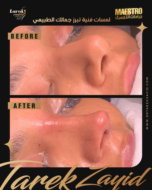 مراحل تغير الانف بعد عملية التجميل